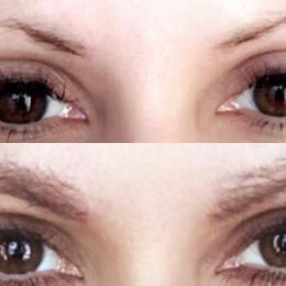 eyebrow transplants photos