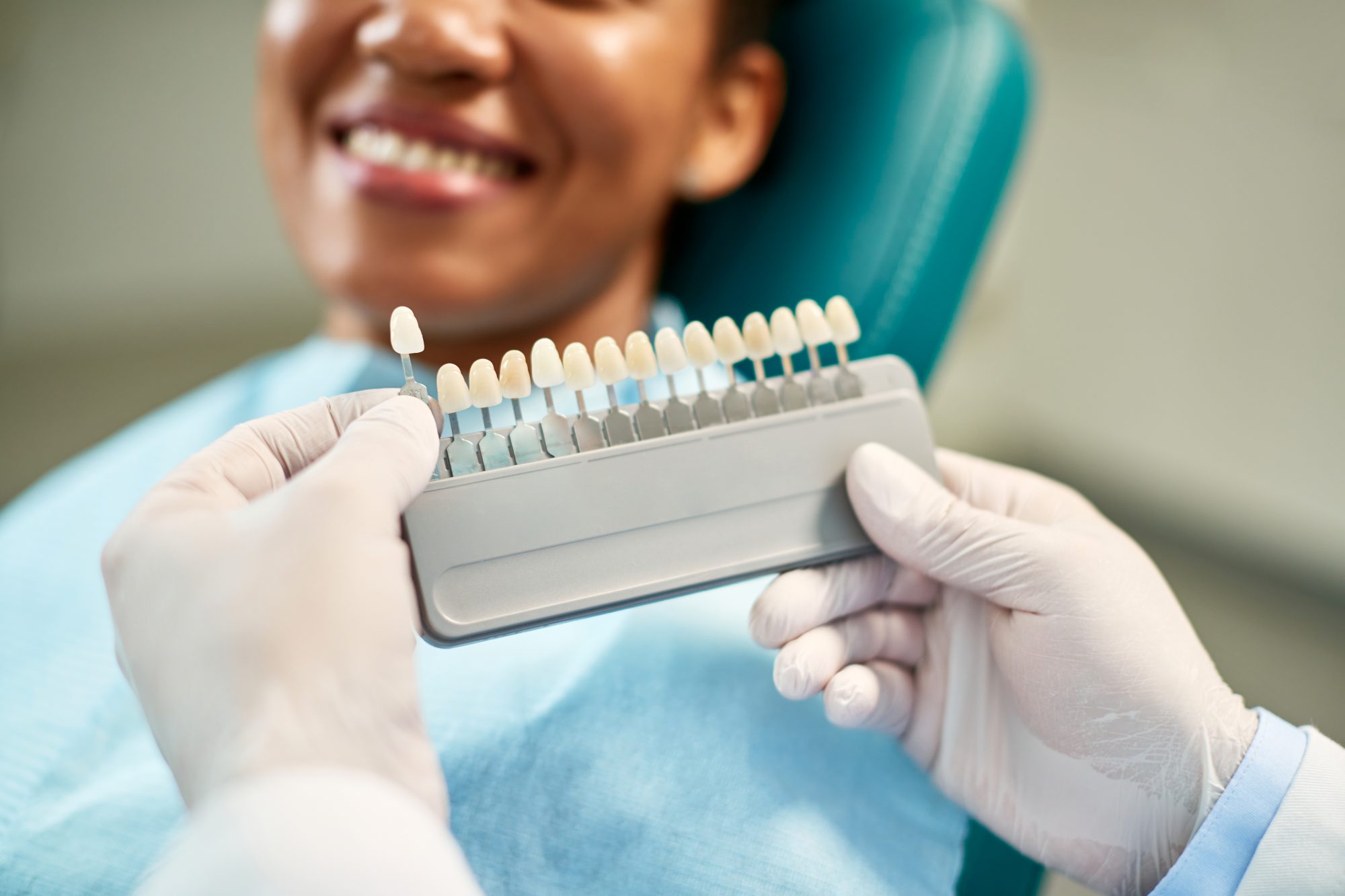 veneers