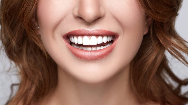 veneers