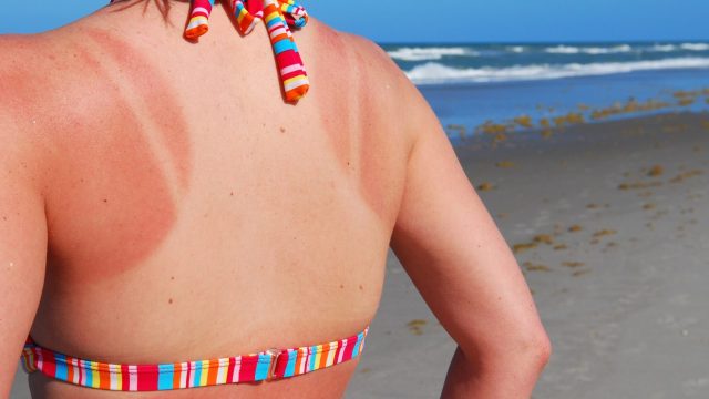 sun allergies allergy sun burn